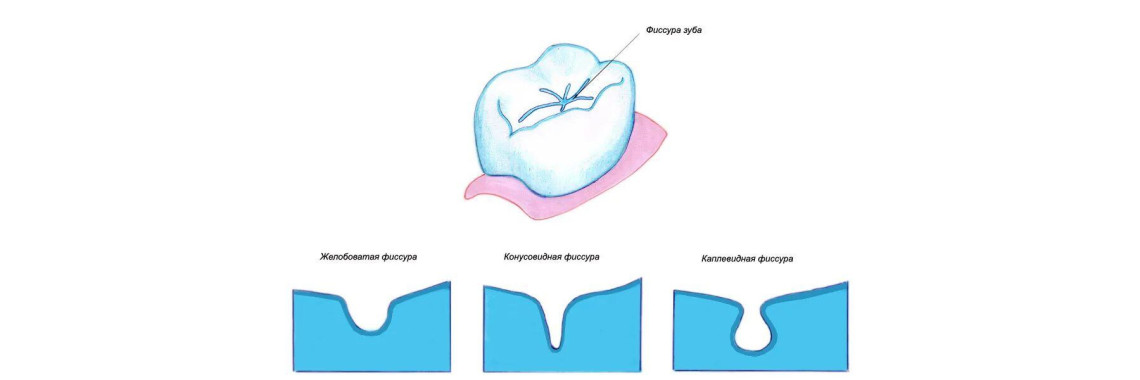 Герметизация фиссур